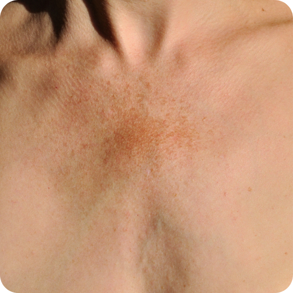 melasma chest